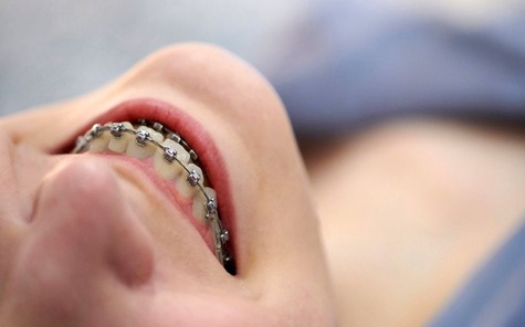 Bagues autoligaturantes blog1