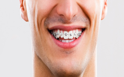 Orthodontie autoligaturante blog1