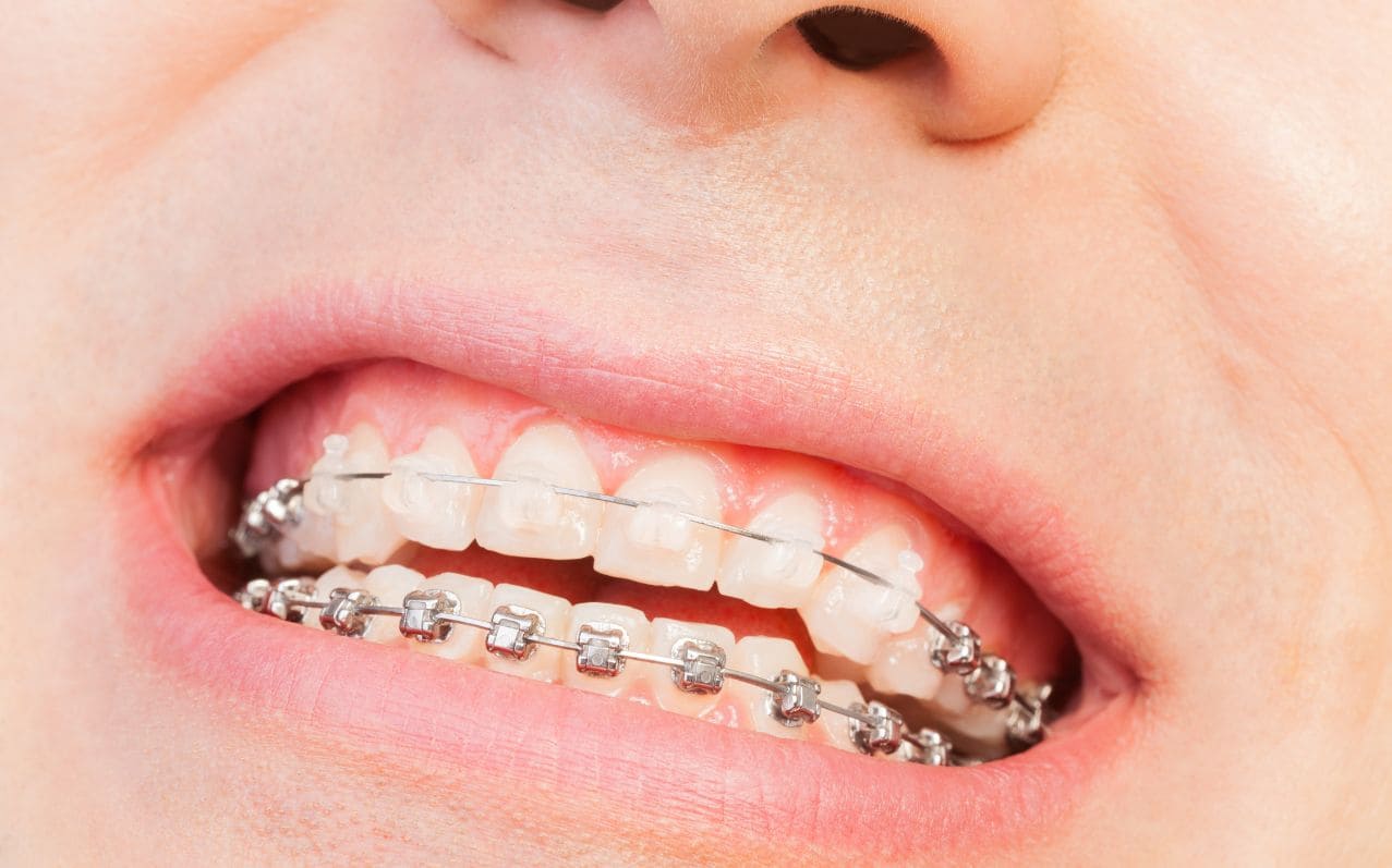 Orthodontie autoligaturante
