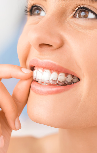 Orthodontie invisible femme