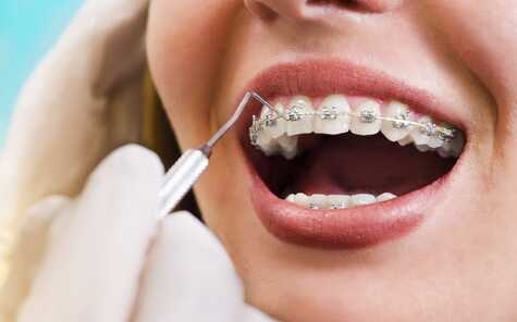 Orthodontie multiattaches blog1