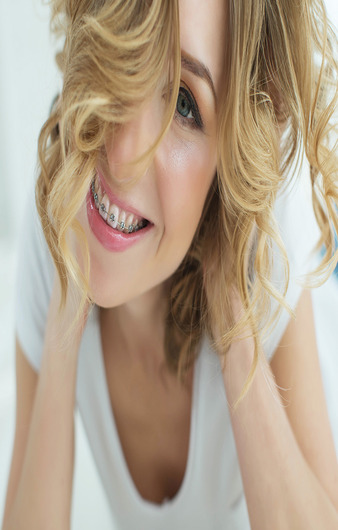 Orthodontie autoligaturante 1