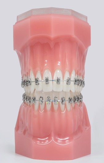 Orthodontie autoligaturante 2