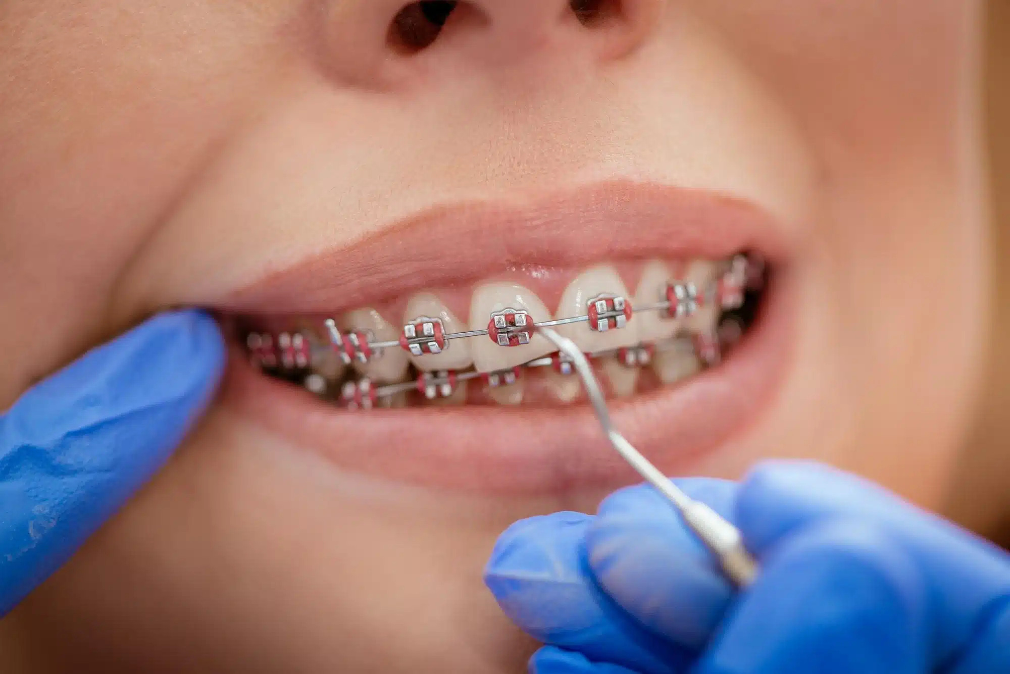 Orthodontie multi attaches 3